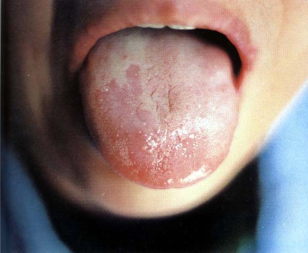 舌苔稍有“異常”或“染色”暗示身體有病！！千萬要注意！...