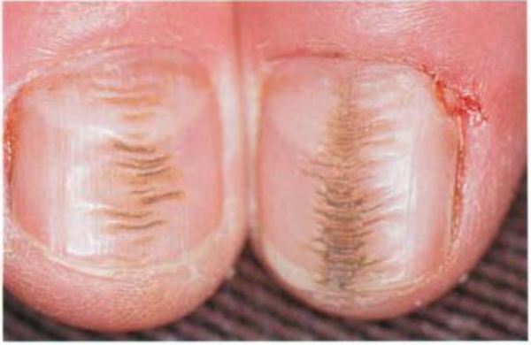 指甲對應內臟健康！指甲上有豎紋，指甲凹凸不平暗示什麼疾病？...