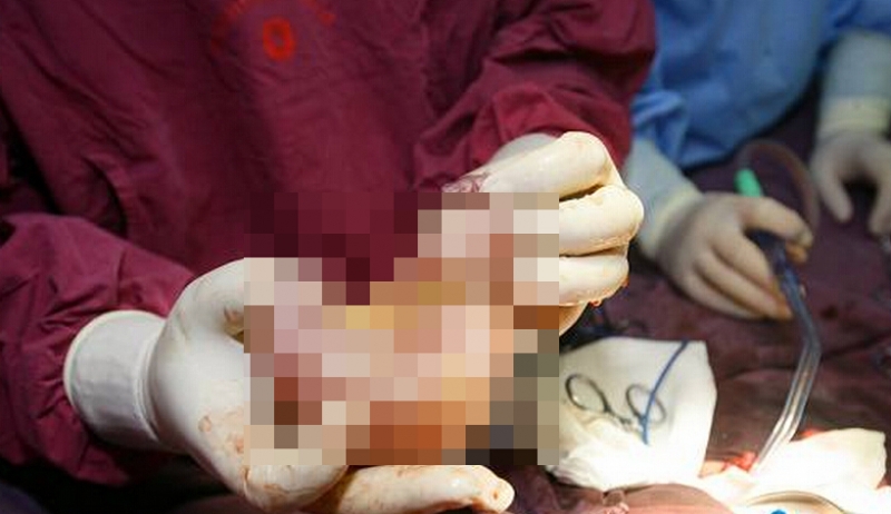 新生男嬰腹中竟藏另一胎實拍醫師手術切除...