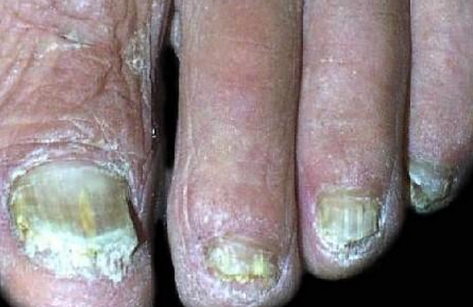 指甲增厚、變形以為是灰指甲？小心有可能是皮膚癌?!...