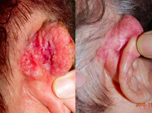 76歲老先生耳朵長「痘痘」一摳竟是耳癌...
