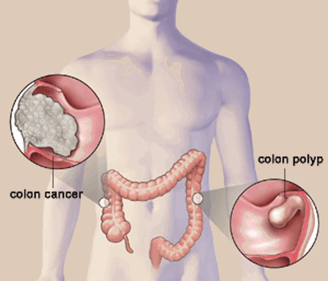 「大腸癌」早期有四大症狀！可惜大多數人都不懂得看！！！...