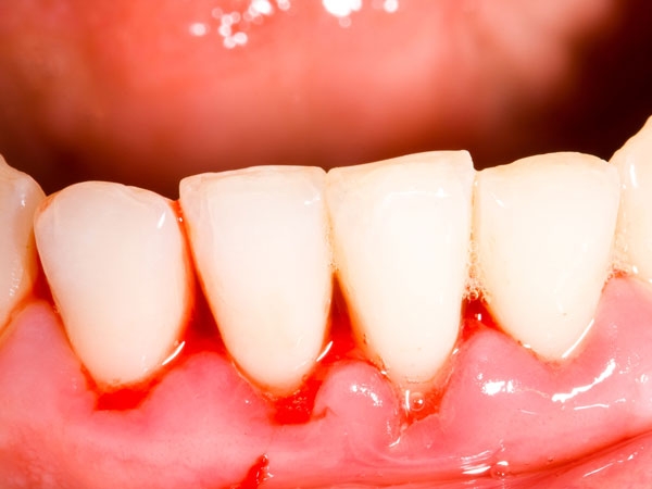 驚~~！！「牙齦出血」竟然是這種病的前兆！！教你一招就能改善...