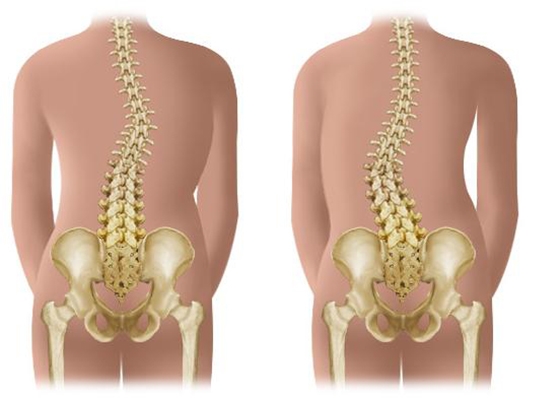 脊椎不好很痛苦，終於找到免錢的矯正脊椎方法了！...