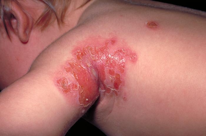 震驚!!一歲女童得了蜂窩性組織炎，竟然是因為媽媽幫她擦這個?...