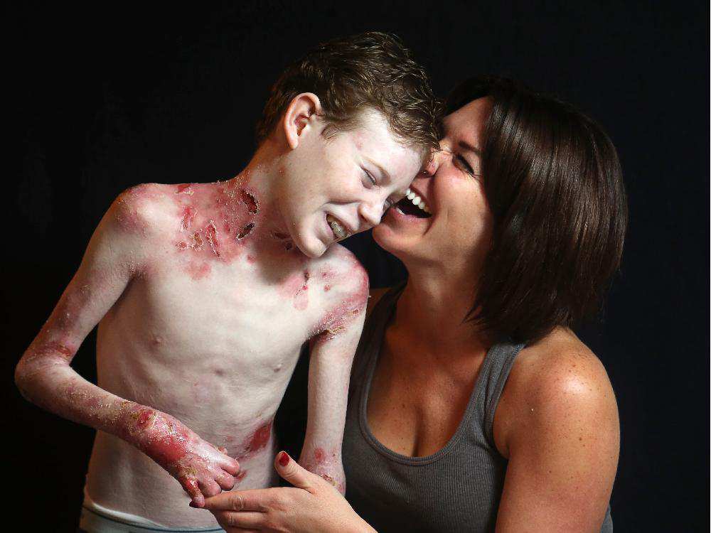 這名14歲的男孩患有罕見的皮膚病，藉著洗澡來減少痛楚，他的故...