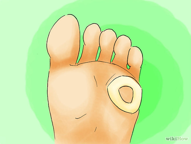 Remove Corns from Your Toes Step 07.jpg