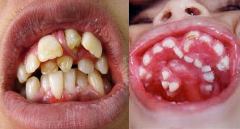 警告！一旦嘴巴裡出現這「8種牙齒」一定要拔掉！一刻都不得久留...