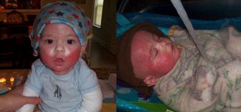 兩歲寶寶臉頰上開始出現紅點，醫生以為是濕疹，沒想到後來媽媽請...