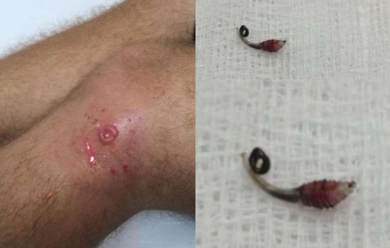 旅客到秘魯被蚊蟲叮咬沒注意，傷口卻轉變成蜂窩性組織炎！當醫生...