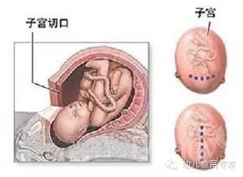 懷二胎孕5月子宮爆裂，寶寶也沒了！孕初期不能忽視的2件事...