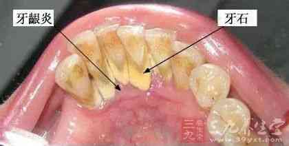 牙結石通常存在於唾液腺開口處的牙齒表面