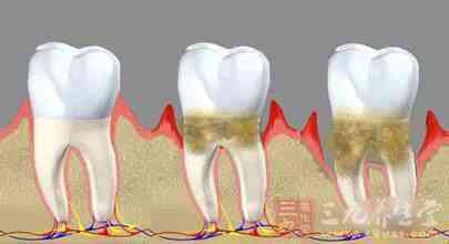 牙結石形成的速度、形態和硬度因人而異