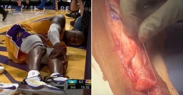 讓當代最偉大籃球員「Kobe」重傷的一場比賽...他的手術過...