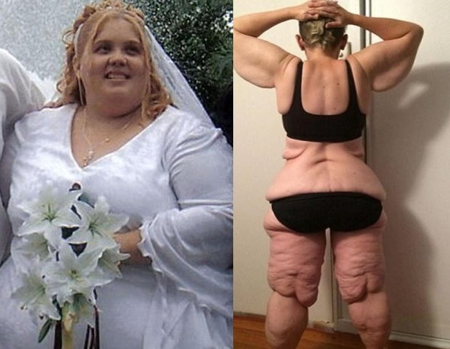 一名35歲女子通過手術瘋狂減重266斤，這項減肥手術卻帶來了...