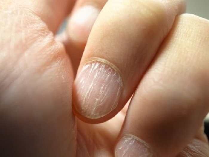 指甲上的「凹槽」竟是腫瘤前兆？１２種「指甲症狀」告訴你身體哪...