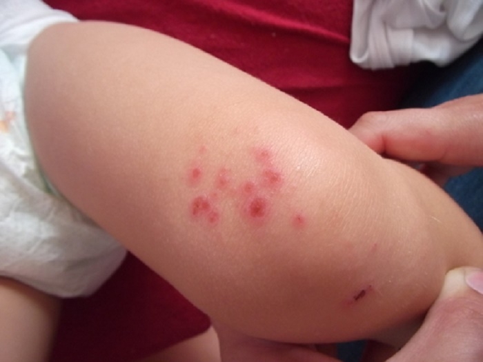 露出肌膚的季節～避免孩子因為植物而「過敏・起疹子」的方法是什...