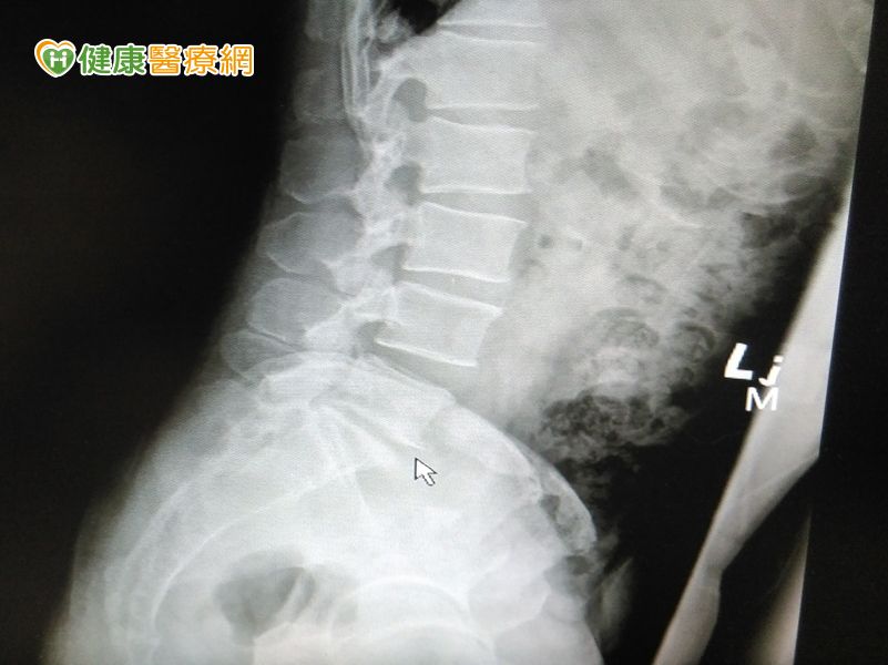 【術前】滑鼠箭頭所指處，即為患者椎間盤突出合併脊椎移位的地方
